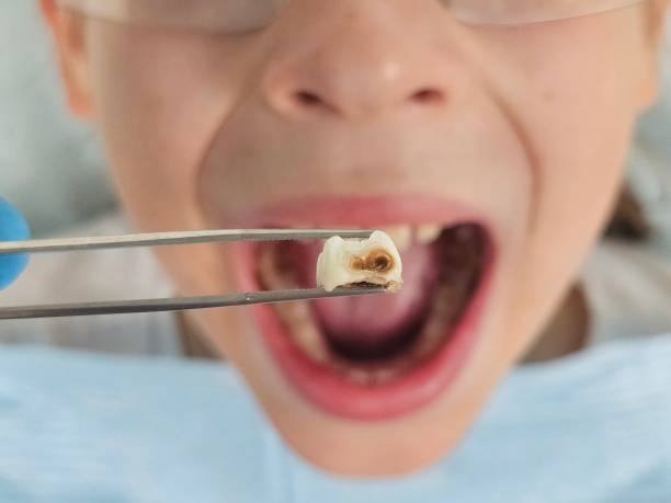 Best Emergency Tooth Extraction in Twin Falls, ID